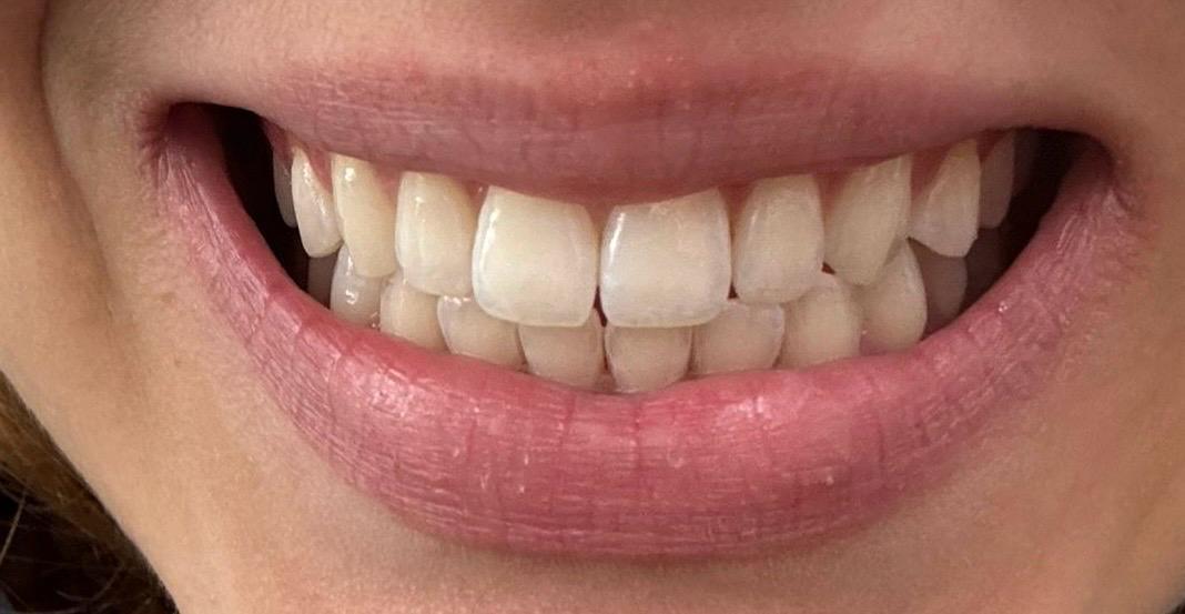 Clareamento dental: depois