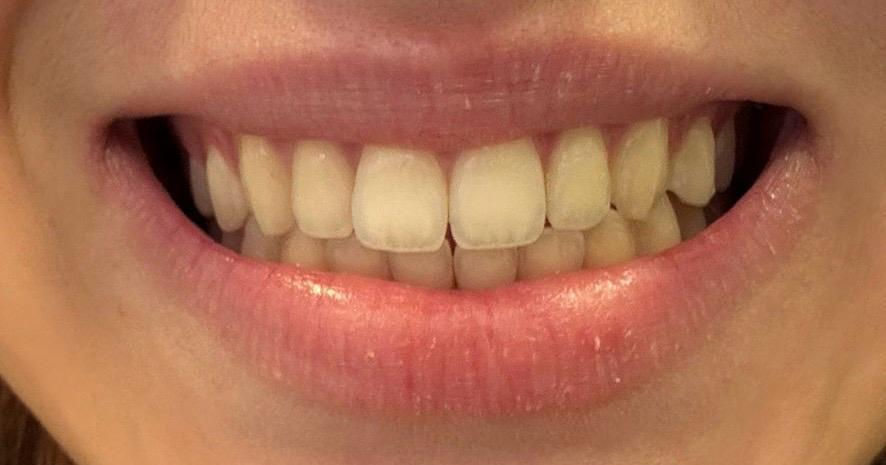 Clareamento dental: antes